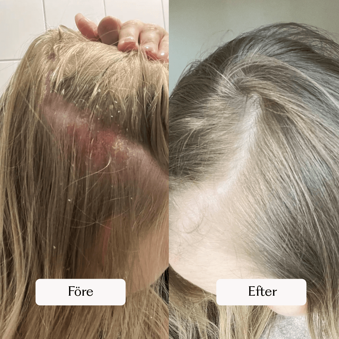 Kundbild före och efter produktanvändning som visar hur produkten har hjälpt till att lugna hårbotten.