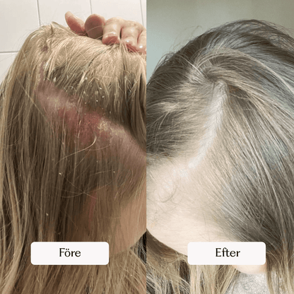 Kundbild före och efter produktanvändning som visar hur produkten har hjälpt till att lugna hårbotten.